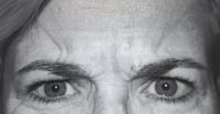 Glabella vor der Behandlung