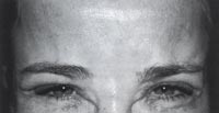 Glabella nach der Behandlung